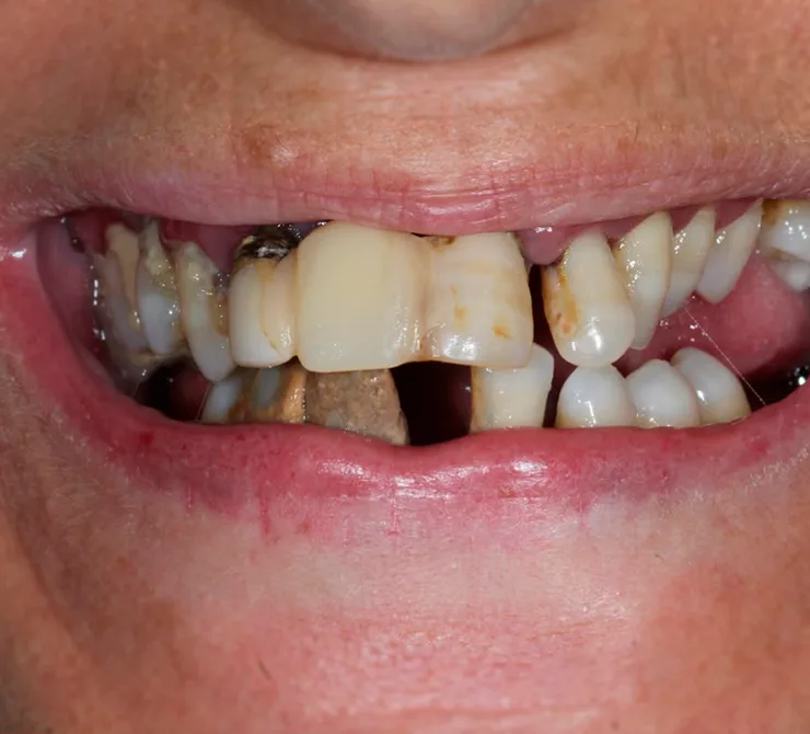 Implantes
