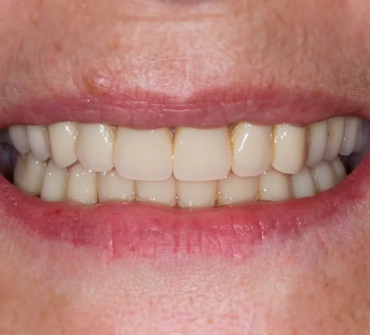 Implantes Dentários