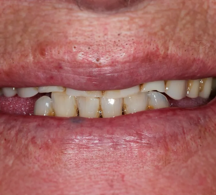 Implantes de dente