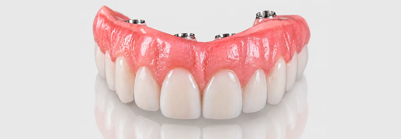 Implantes dentários